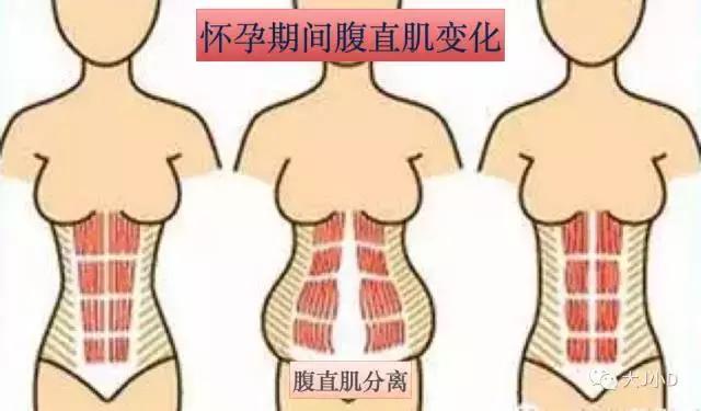 你的腹直肌分离了吗？