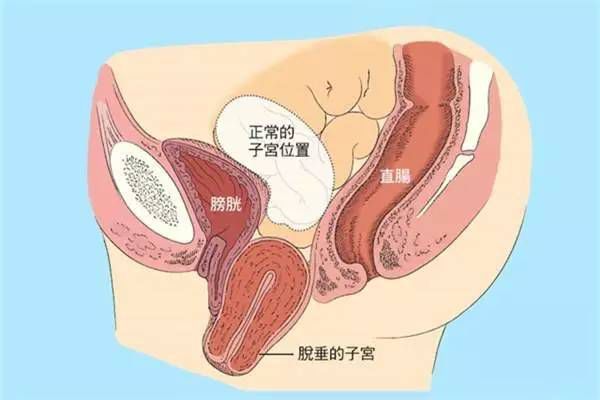 【产后修复】盆腔脏器脱垂，你有吗？