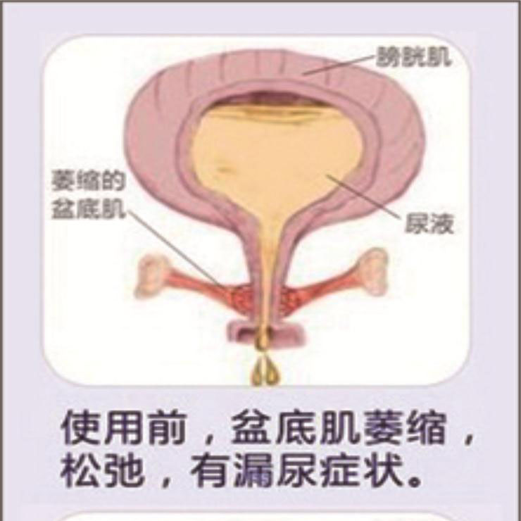 产后盆底肌康复|“社交癌”盯上你了吗？