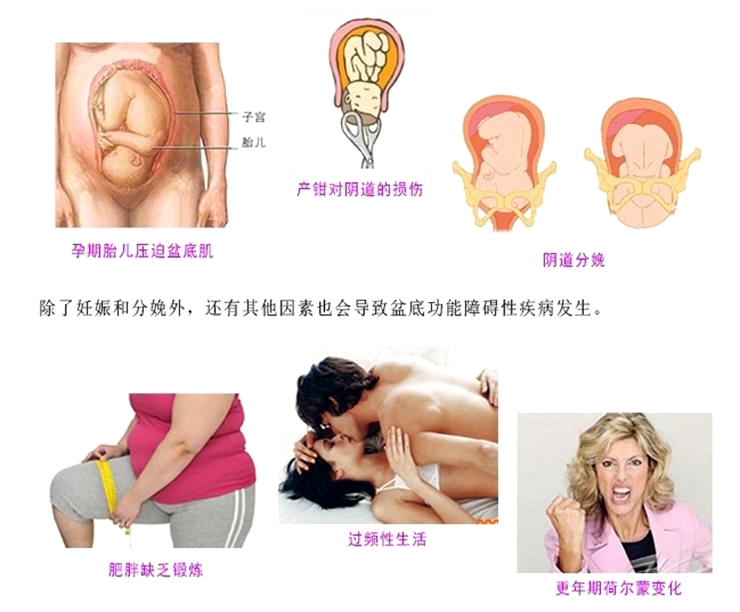 产后康复治疗很重要，慢性盆腔痛很重要