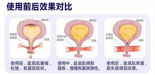 盆底康复治疗怎么做？产后盆底功能检测很重要