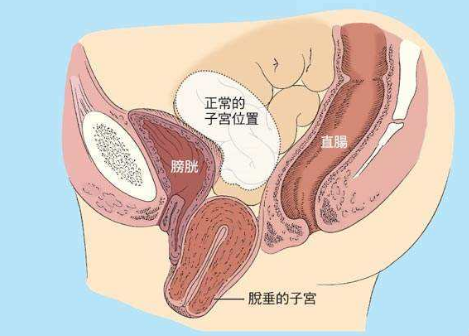 人们常说，产后女性做好盆底肌修复是关键，但盆腔器官的脱垂你也得注意