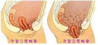 盆底功能检测之何为子宫脱垂，如何辨别？