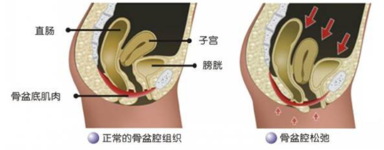 盆底功能检测很重要，盆底肌松弛了会有什么表现呢？