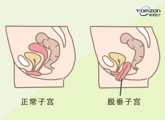 你害怕子宫脱垂吗？盆底肌修复仪器来拯救你