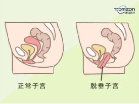 盆底肌修复仪器用对地方治疗很有效