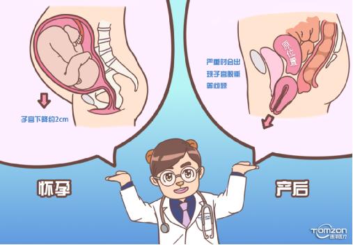 引起子宫下降可用盆底肌修复仪器干预