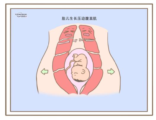 腹直肌分离可以使用盆底肌修复仪器吗？