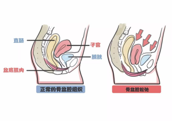 骨盆修复