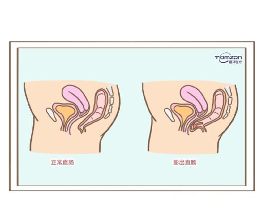 盆底肌修复仪器.jpg