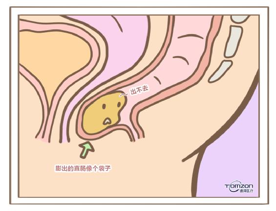 盆底康复治疗仪