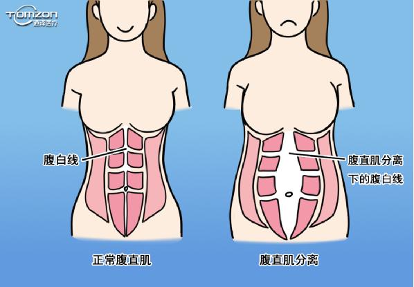 盆底肌修复仪器